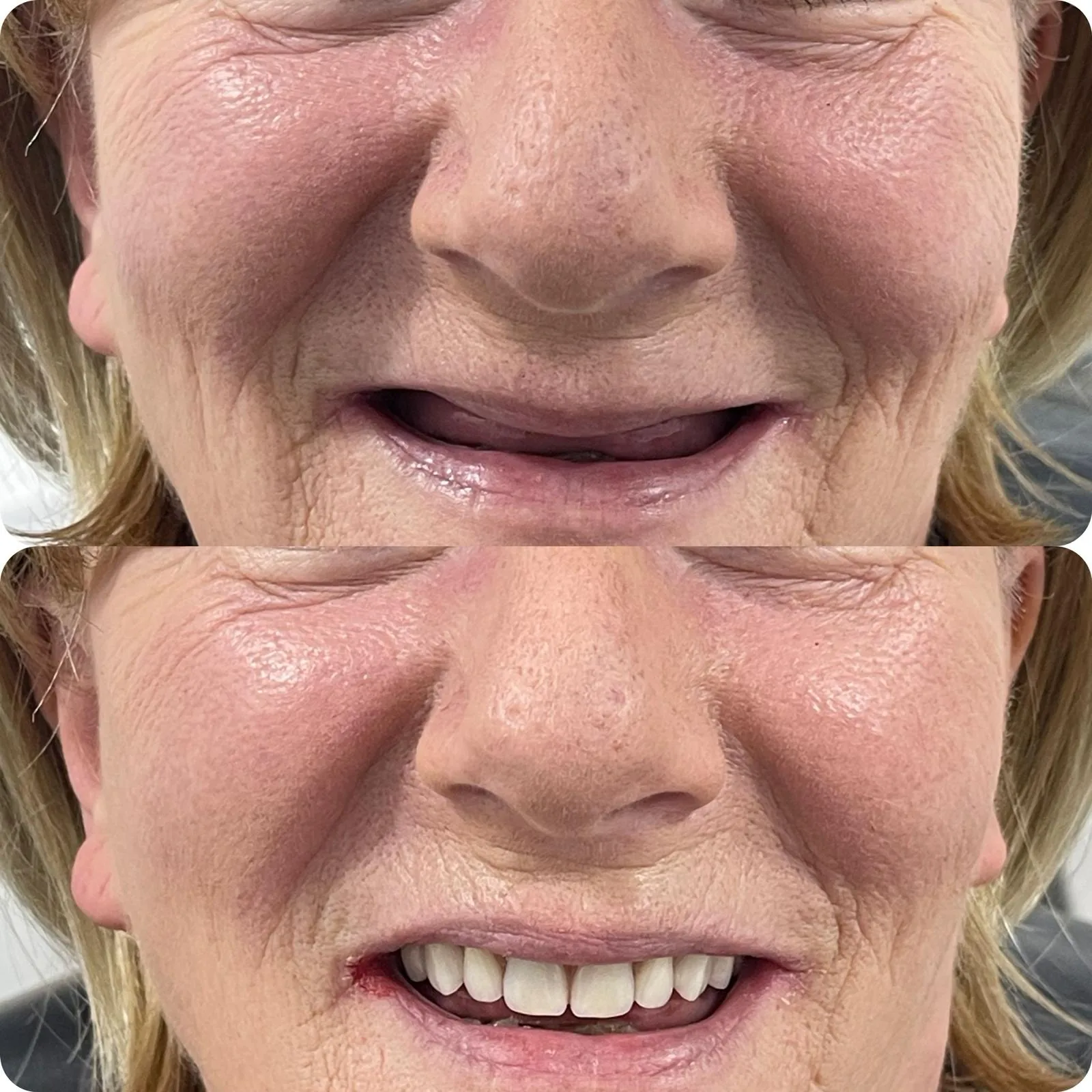 Before and after dental implant treatment